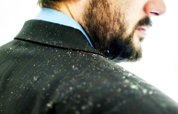 Πιτυρίδα ή ξηροδερμία: Πώς να την αναγνωρίσετε και τι μπορείτε να κάνετε